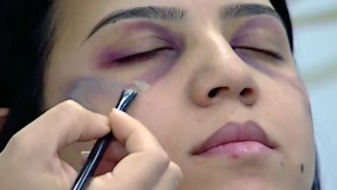 The makeup artist showed how to cover facial bruising with concealer.