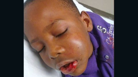 Trayvon Grayson, 7, after the incident.