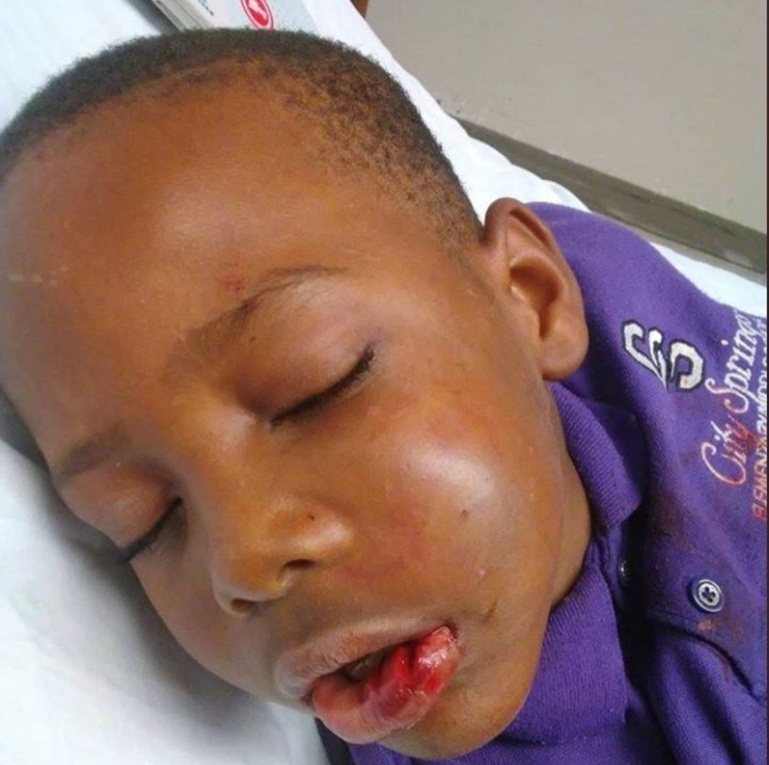 Trayvon Grayson, 7, after the incident.