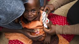 Young child is screened for malnutrition at the International Rescue Committee stabilization center in Maiduguri, northeastern Nigeria