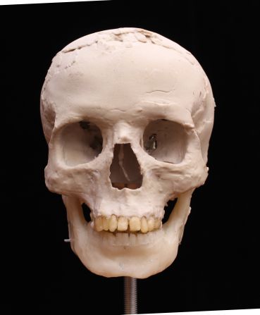A model of the skull was 3D-printed with a full set of teeth and a new lower jaw.