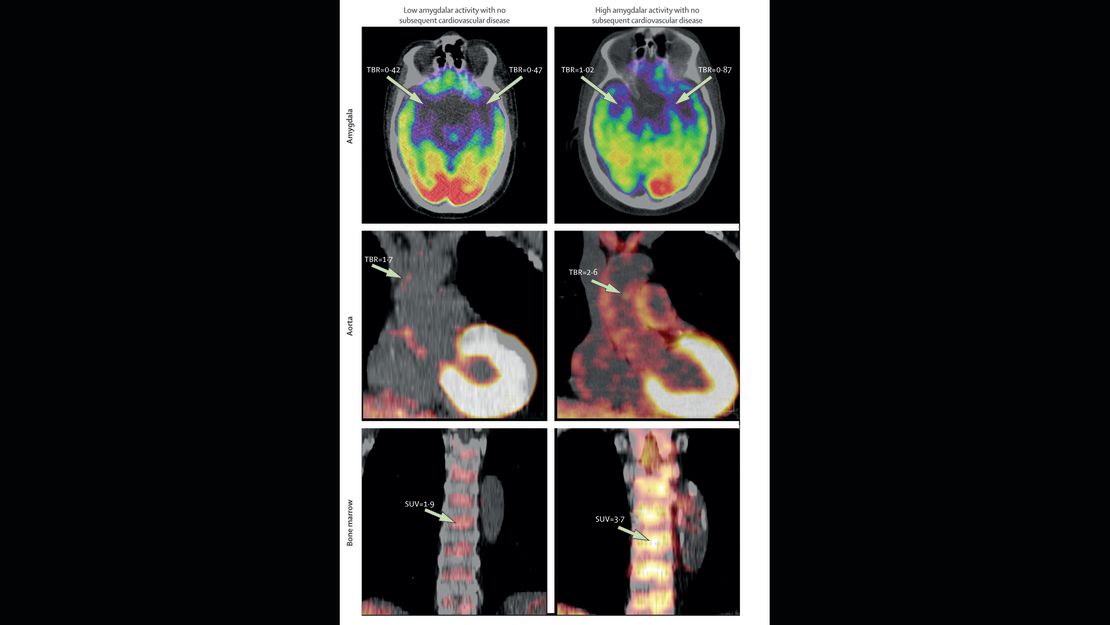 Views of the amygdala, arteries and bone marrow of two adults, showing differences in low, left, and high amygdala activity.