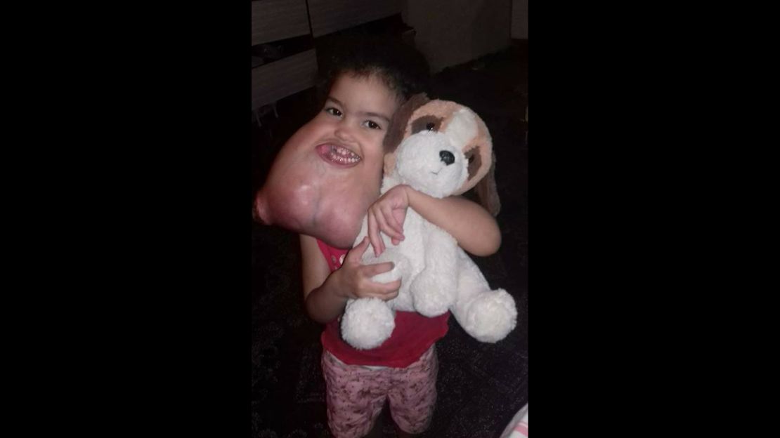 Doctors estimated that Melyssa Delgado Braga's tumor weighed 5 pounds.