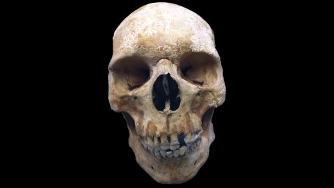 Sk27's skull shows no obvious signs of leprosy, although he probably experienced facial paralysis in life.