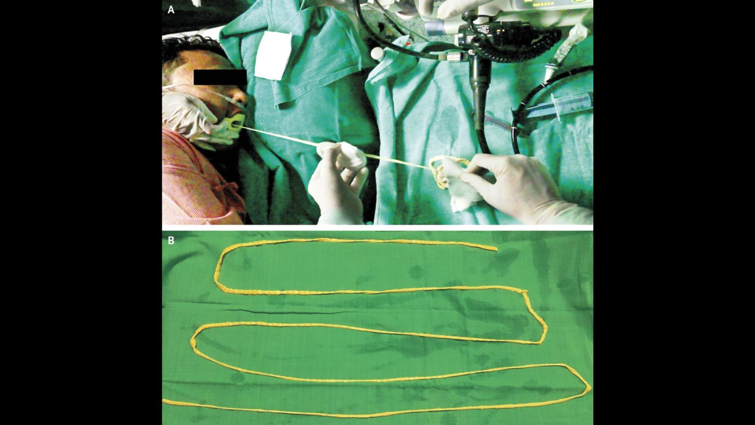 Doctors sedated the man and removed this 6-foot-long tapeworm through his mouth.
