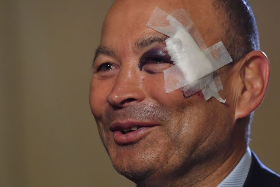 Since taking over from Stuart Lancaster after the World Cup, former Australia and Japan coach Eddie Jones has guided largely the same squad of players to 13 successive victories. His only black eye so far came on the eve of the 2017 Six Nations tournament, which he first attributed to a slip in his bathroom -- and later a training accident.