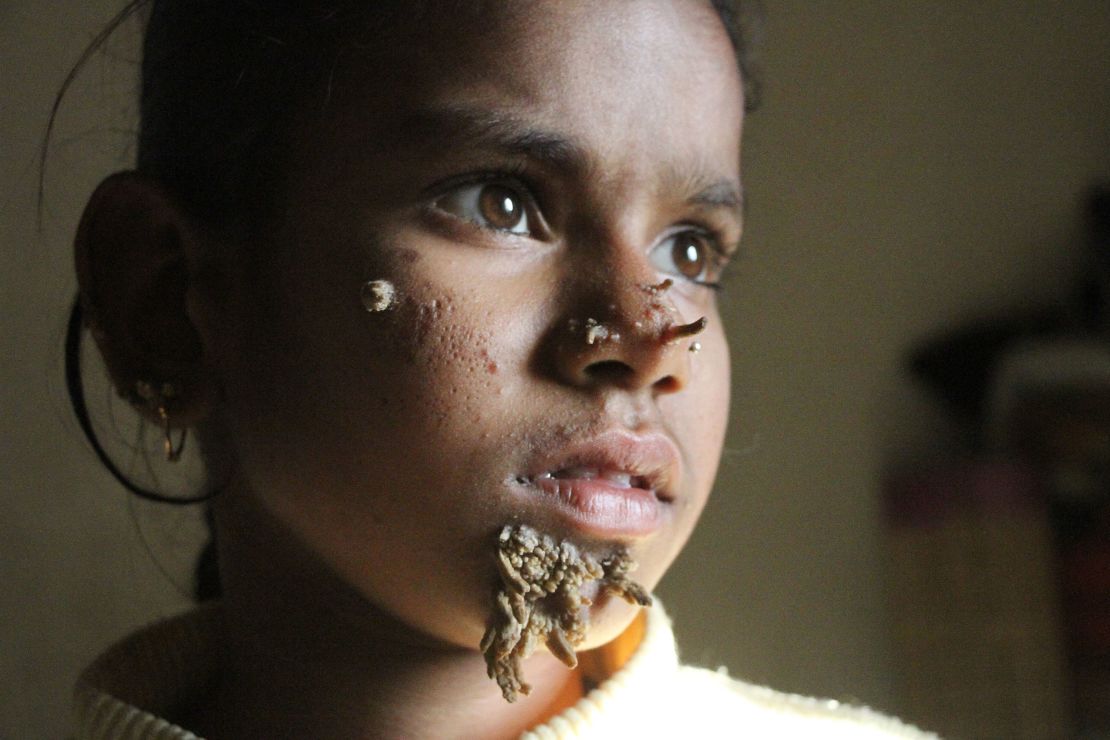 Sahana Khatun, 10, came to the hospital with bark-like warts growing on her face.