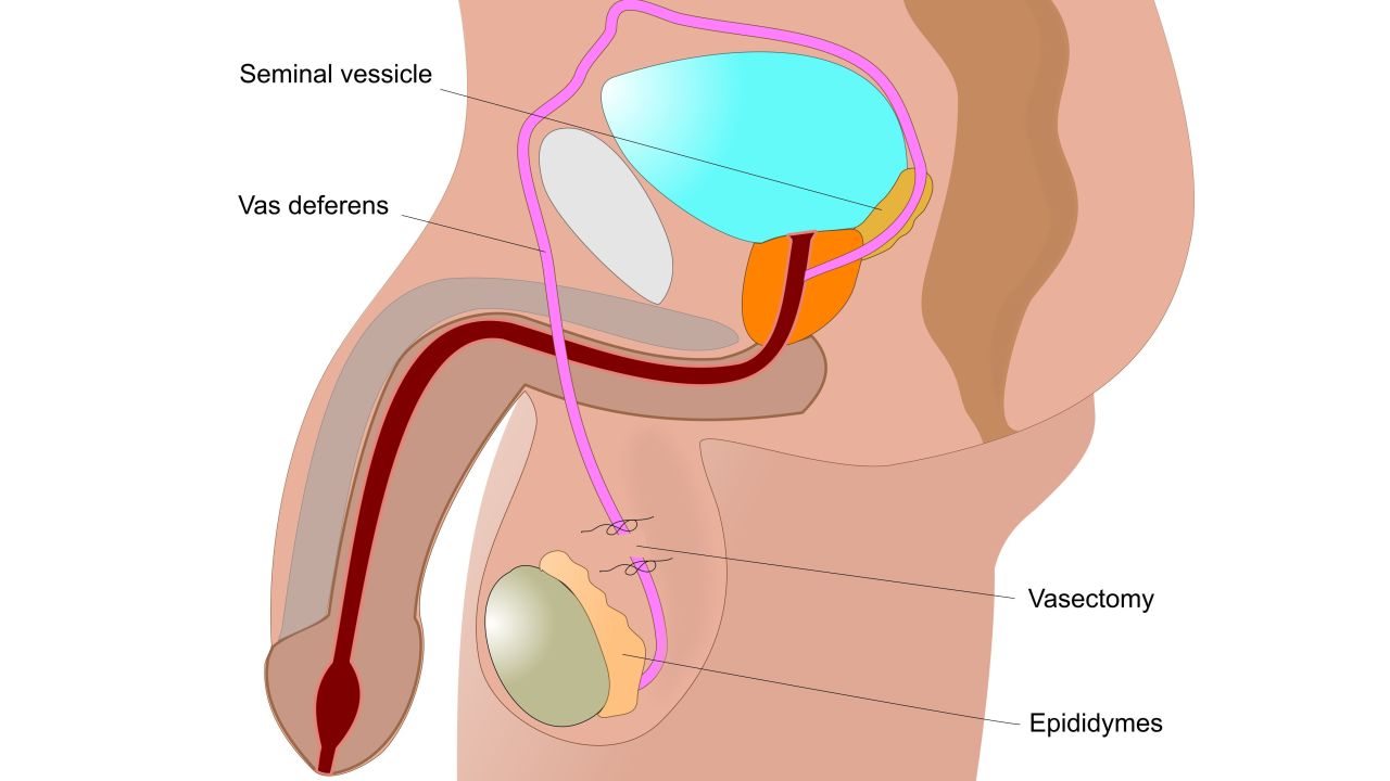 During a vasectomy, a surgeon cuts the vas deferens, the tubes that carry sperm from the testicles. It has a failure rate of about 0.15% and can be reversed, but the procedure is complicated.