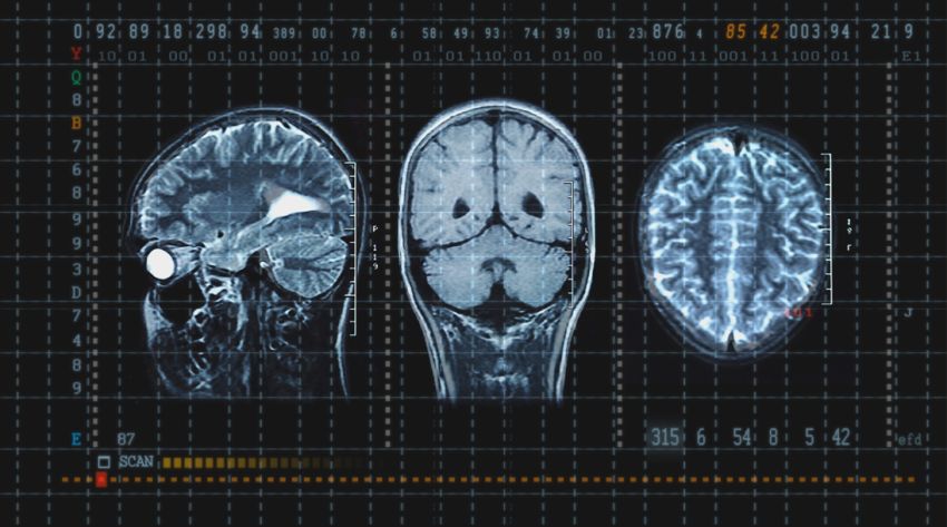 concussion scan images