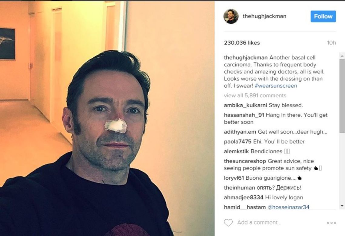Hugh Jackman recently underwent treatment for basal cell carcinoma, again, according to a social media post. The Australian actor has been treated for basal cell carcinoma at least four times.