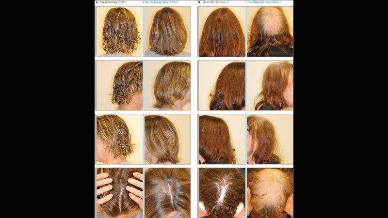 Cancer treatments cause hair loss or hair changes  Cancer Hair Care