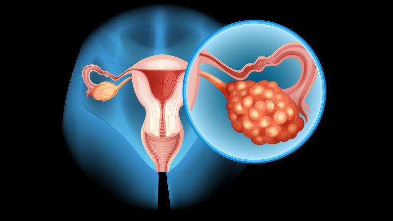 Ovarian cancer is a rare but deadly reason for a bloated belly. It usually goes along with other <a href="index.php?page=&url=http%3A%2F%2Fwww.bmj.com%2Fcontent%2F339%2Fbmj.b2998" target="_blank" target="_blank">telltale signs </a>such as abdominal pain, urinary frequency, postmenopausal and anal bleeding, and a loss of appetite. So if you've suddenly developed abdominal distension in the past few months and have any of these other symptoms, see a doctor immediately. And don't rely on the results of your Pap test; that's effective only in the early detection of cervical cancer.