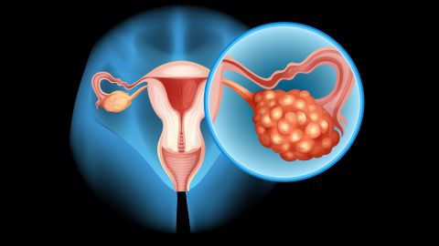 Ovarian cancer is a rare but deadly reason for a bloated belly. It usually goes along with other <a href="http://www.bmj.com/content/339/bmj.b2998" target="_blank" target="_blank">telltale signs </a>such as abdominal pain, urinary frequency, postmenopausal and anal bleeding, and a loss of appetite. So if you've suddenly developed abdominal distension in the past few months and have any of these other symptoms, see a doctor immediately. And don't rely on the results of your Pap test; that's effective only in the early detection of cervical cancer.