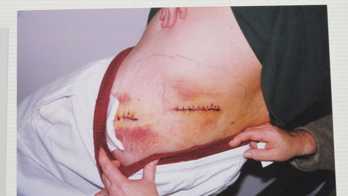 The rookie LAPD officer's wounds.