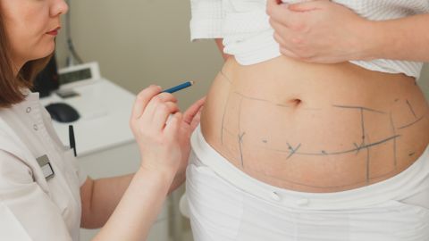 Liposuction, which is intended to remove excess body fat, was the second most-popular with 235,237 procedures.