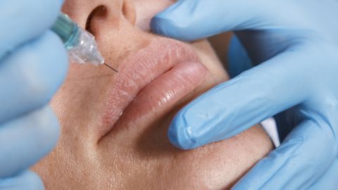 Soft-tissue fillers, injected in an effort to create a smoother or fuller appearance in the face or lips, were the second most-popular, with 2.6 million procedures.