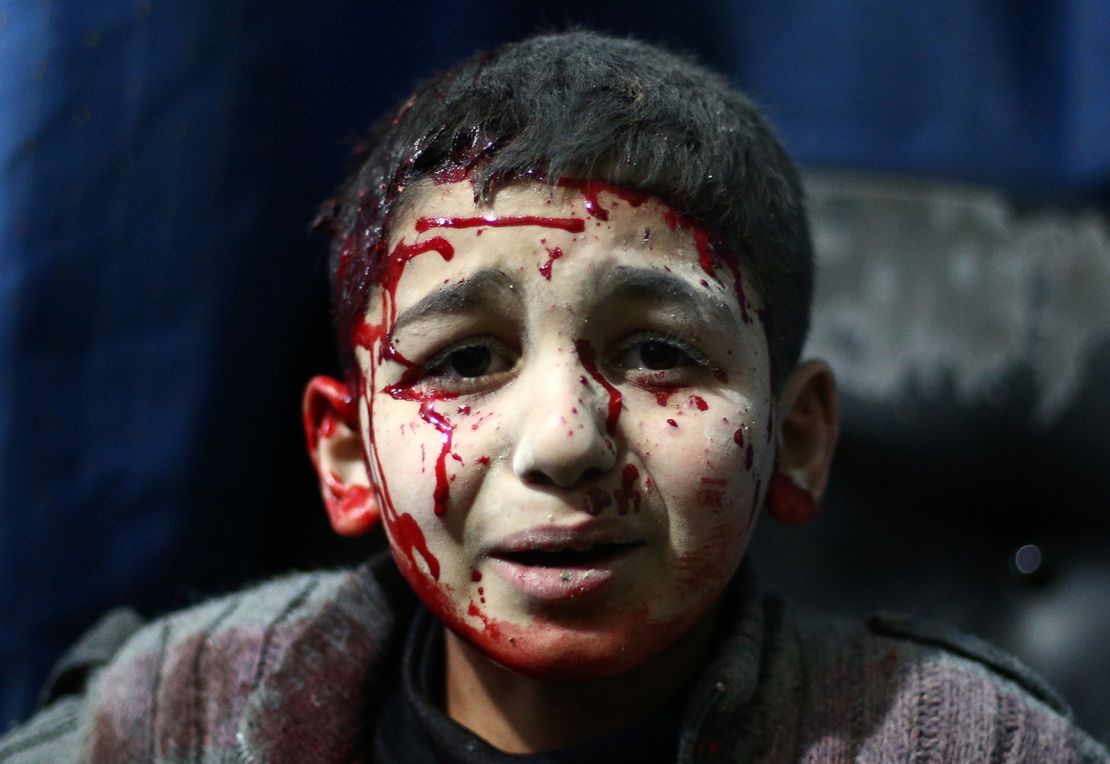 An injured Syrian child waits for treatment at a makeshift hospital in the rebel held area of Douma, north east of the capital Damascus on February 2, 2015. 