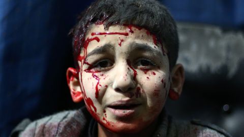 An injured Syrian child waits for treatment at a makeshift hospital in the rebel held area of Douma, north east of the capital Damascus on February 2, 2015.