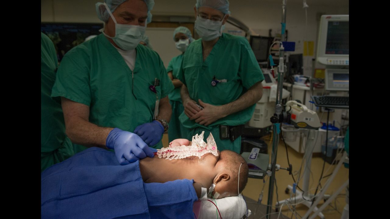 Pediatric plastic/reconstructive surgeon Dr. Frank Vicari shows the operating room team the model of Dominque's spine created for this complicated procedure.