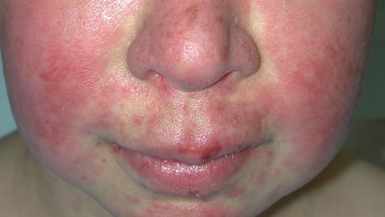 A "butterfly rash" on the face occurs in about half of cases.