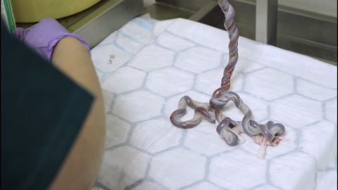 An umbilical cord ready for blood to be extracted at the hospital.