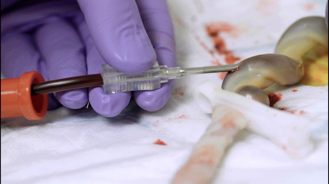 Blood is extracted from an Umbilical cord at UCLH in London.