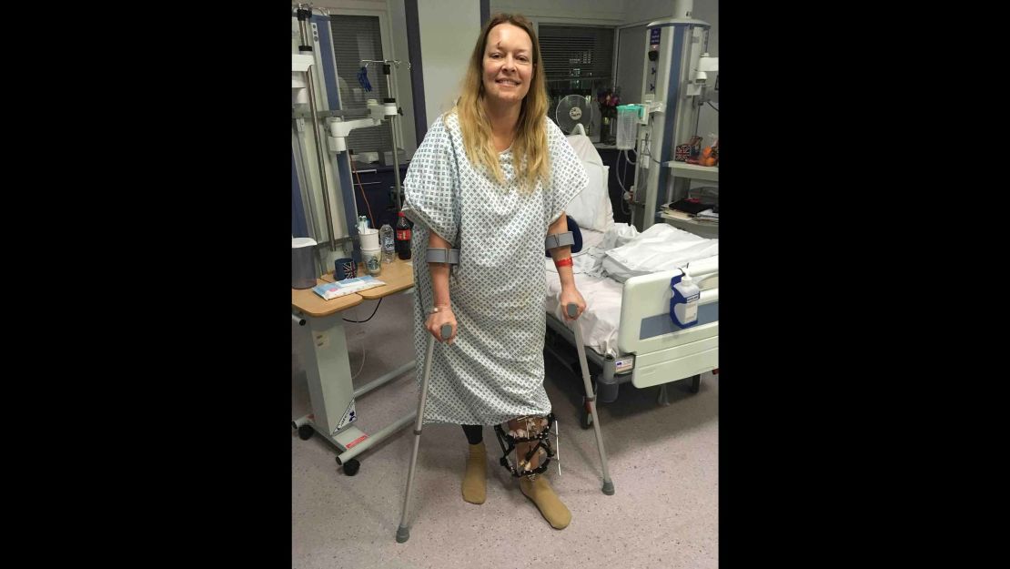 Melissa Cochran, in a photo posted by her brother, is recovering from a broken leg and other injuries.