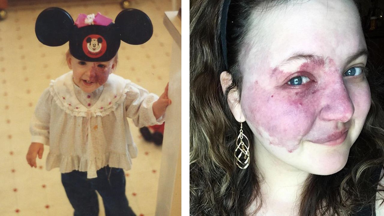Crystal Hodges has had a birthmark on the left side of her face since birth. Roughly three in 1,000 people have this type of birthmark, called a port-wine stain.