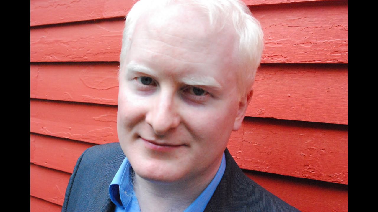 Actor Dennis Hurley, who is albino, said his skin condition affects the kinds of roles he auditions for.