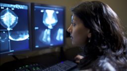 Dr. Mitva Patel, a breast radiologist at the Ohio State University Comprehensive Cancer Center-Arthur G. James Cancer Hospital and Richard J. Solove Research Institute, routinely evaluates mammograms. She believes women should start getting mammograms at age 40.