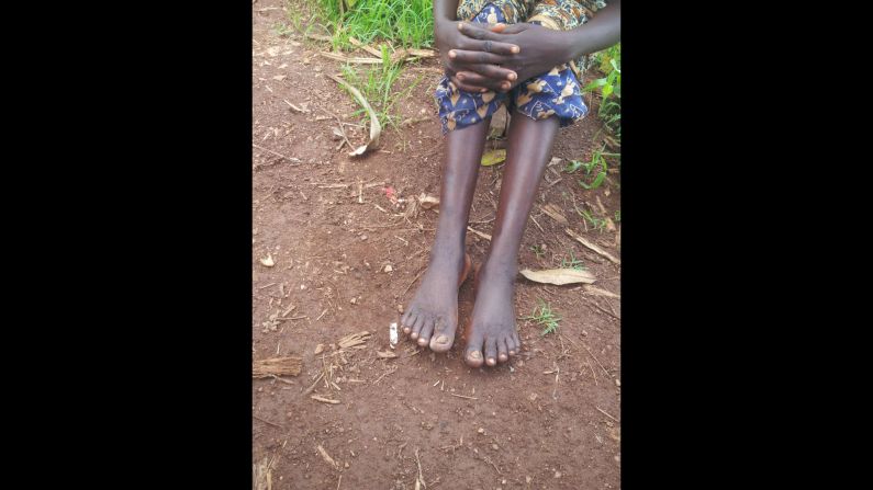 This method of contracting the disease, through volcanic soil, is known as podoconiosis, or non-filarial elephantiasis. Pictured, an early manifestation of podoconiosis, involving mild lymphedema (swelling) with a few warty growths on the feet. 