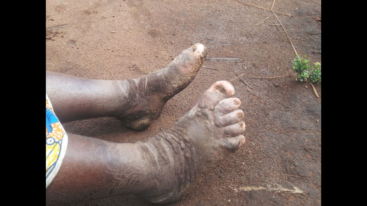 A recent epidemic of elephantiasis was reported in the Kamwenge District of western Uganda. Pictured, asymmetrical lymphedema (lower limb swelling) typical of the disease. An investigation by the country's Ministry of Health highlighted the root cause to be volcanic soil. 