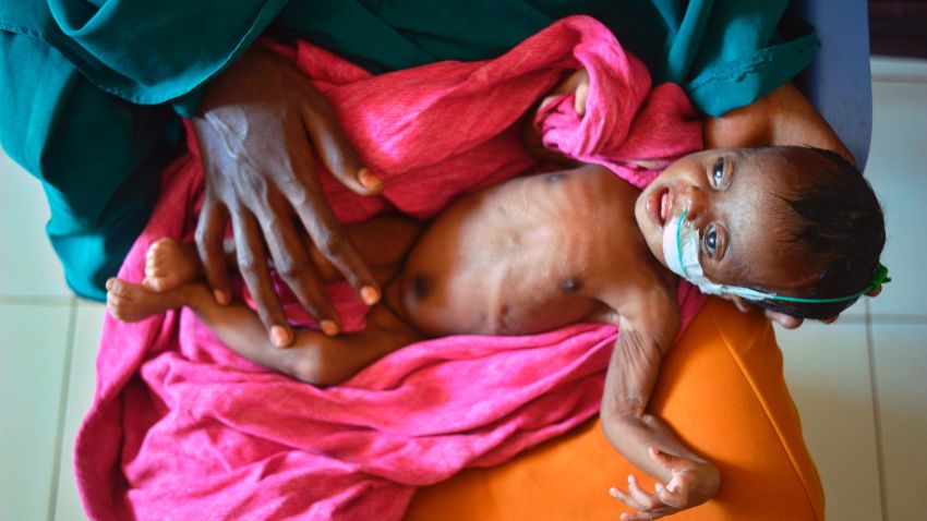 TOPSHOT - A severely malnourished child in the hands of her mother waits to be processed into a UNICEF- funded health programme catering to children displaced by drought, at the regional hospital in Baidoa town, the capital of Bay region of south-western Somalia where the spread of cholera has claimed tens of lives of IDP's compounding the impact of drought on March 15, 2017.
The United Nations is warning of an unprecedented global crisis with famine already gripping parts of South Sudan and looming over Nigeria, Yemen and Somalia, threatening the lives of 20 million people. For Somalis, the memory of the 2011 famine which left a quarter of a million people dead is still fresh.
 / AFP PHOTO / TONY KARUMBA        (Photo credit should read TONY KARUMBA/AFP/Getty Images)