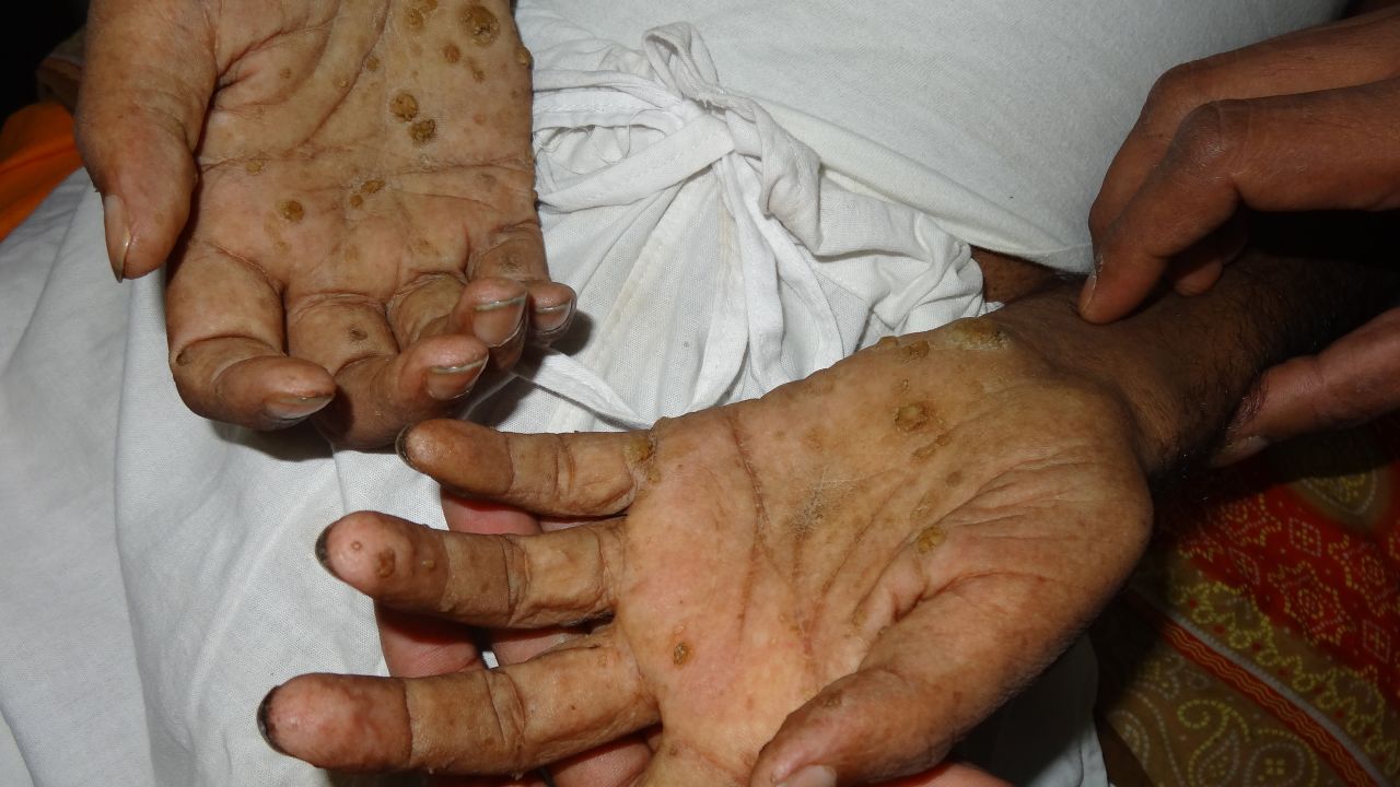 Keratosis is a symptom of arsenic poisoning.