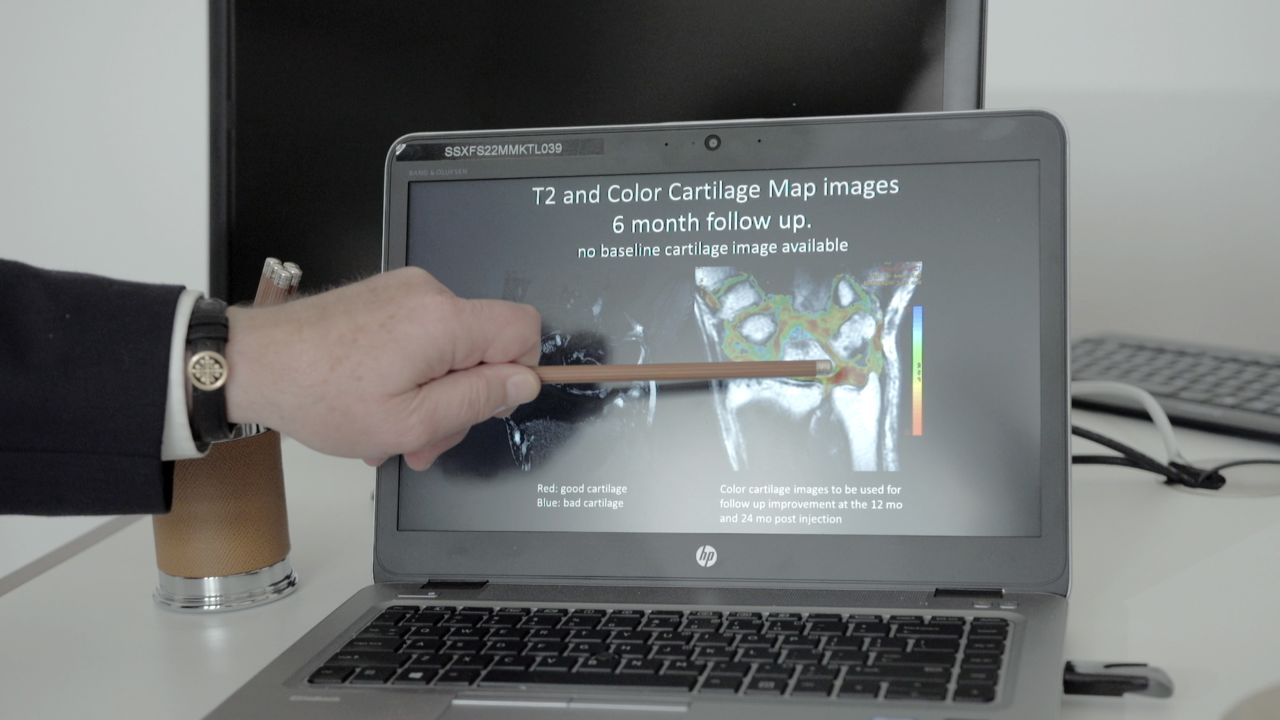 Dr. Eckhard Alt points out a spot on Bill Marlette's MRI, taken after he received an injection of his own stem cells into his wrist.