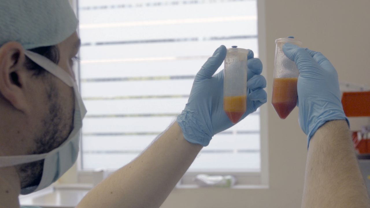 Stem cells are taken from fat tissue with a liposuction procedure. An enzyme mixture helps to separate the stem cells from oil and fat tissue, with the stem cells settling at the bottom of the vial.