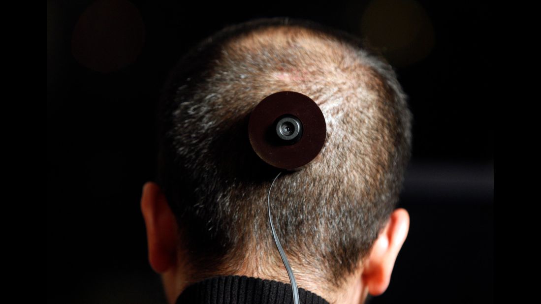 On Dec. 5, 2010, photography professor and artist Wafaa Bilal has a camera implanted in the back of his head for conceptual project "The 3rd I." The idea was that an image would be taken every minute for a year, and streamed live on the internet and a Qatar galler. Alas, a few months in, Bilal was forced to remove the titanium plate attached to his skull when his body rejected it, leaving the artist in constant pain.