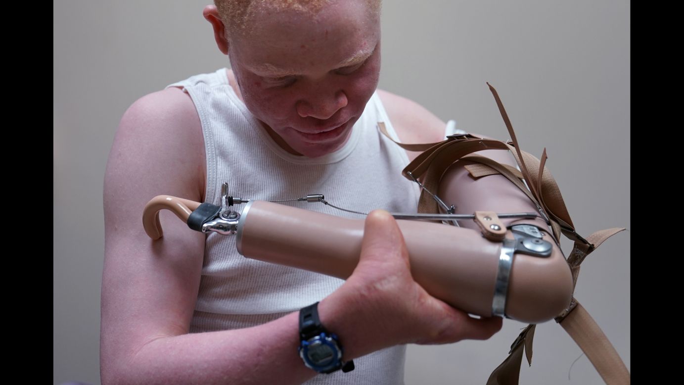 Prosthetics: Meet the man with 13 legs - BBC Future