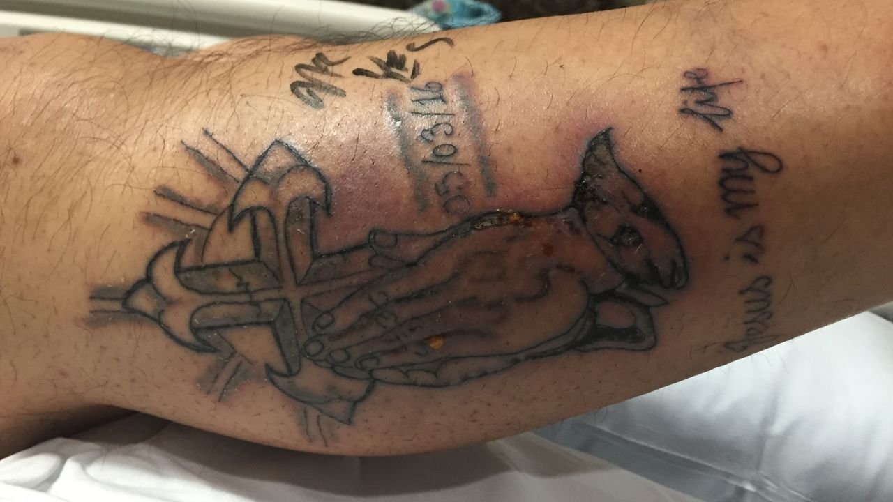 A 31-year-old Texas man got a tattoo on his right leg, according to a case study in the journal BMJ, and went swimming in the Gulf of Mexico five days later.