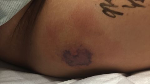 Man Dies After Swimming With New Tattoo Cnn