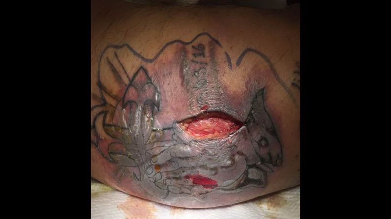 The tattoo two weeks after admission. The man was kept largely sedated for weeks.