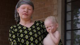 ukerewe tanzania albino 2