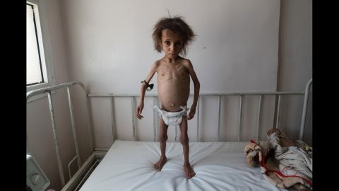 Batool Ali, aged 6, stands on a hospital bed in Saada City, Yemen. Batool is suffering from severe acute malnutrition. The pouch attached to her arm contains a potion used to ward off snakes while families take shelter in the desert overnight. 