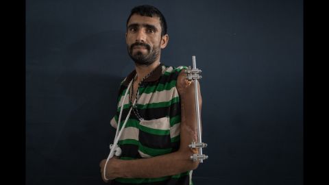 Majed Shoei was injured six months ago when a bomb exploded near him. Money is tight for the father-of-eight, who used to be a construction worker, but is unable to work because of his health and so cannot afford to pay his medical bills. 