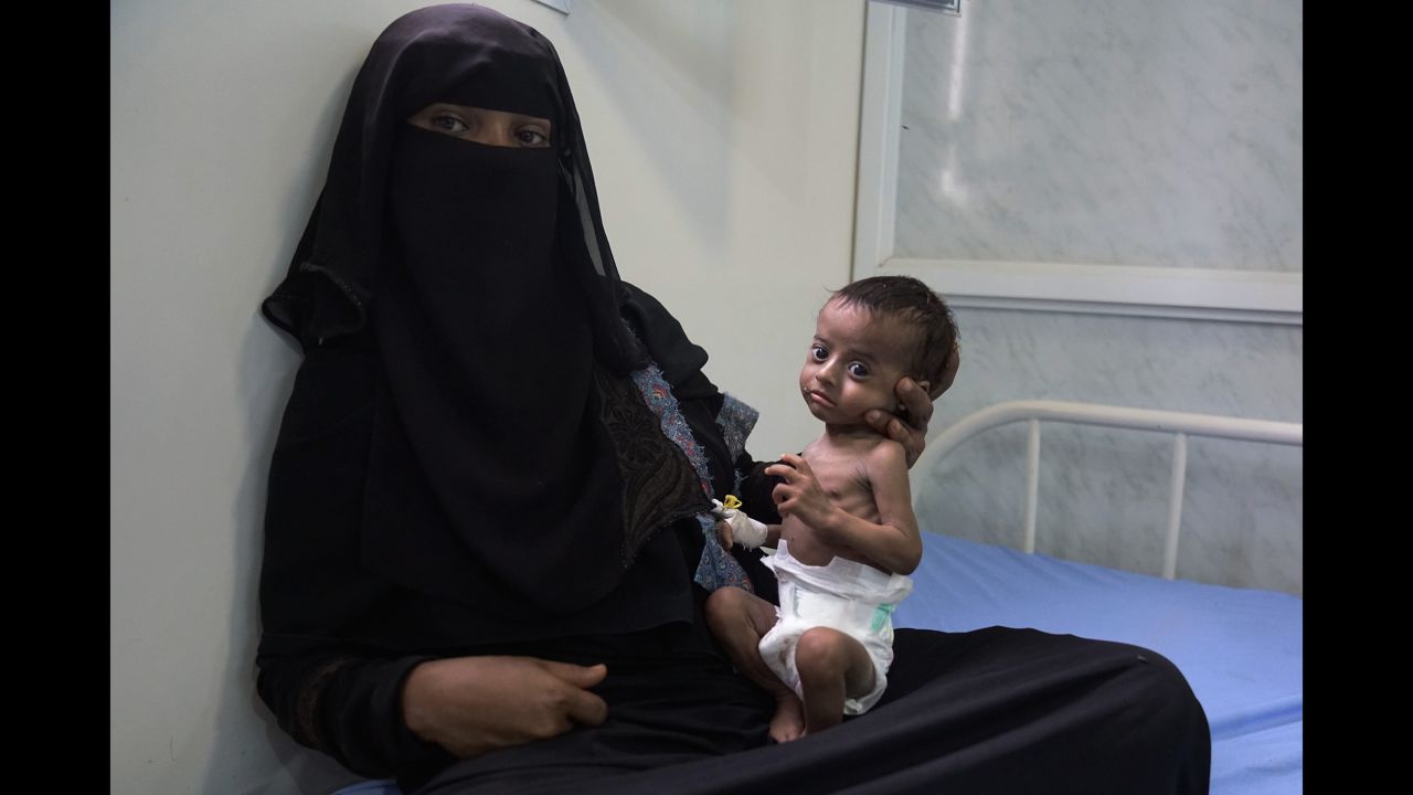 Saleh is four months old and severely malnourished. His 22-year-old mother, Nora, already has five children -- the first was born when she was just 12, after a forced marriage at the age of 11. 