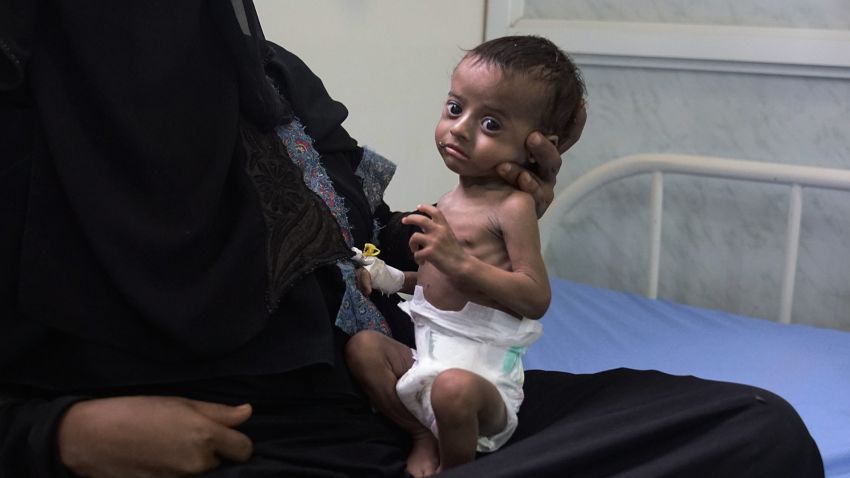 AL THAWRA HOSPITAL, AL HUDAYDAH, YEMEN - 15 APRIL 2017.Saleh is four months old and suffers from severe acute malnutrition. He weighs 2.5 kg and was admitted to hospital on 14 April 2017. His 22-year-old mother, Nora, already has five children. She was forcibly married at the age of 11, and had her first child when she was 12.Among displaced families in Yemen, child marriage has become an increasingly common coping strategy. A 2016 thematic assessment by UNFPA and INTERSOS on child marriage found that a trend previously in decline is now soaring.According to the latest UN figures, 462,000 children suffer from severe acute malnutrition in Yemen today, a nearly 200% increase since 2014.Giles Clarke/UN OCHA