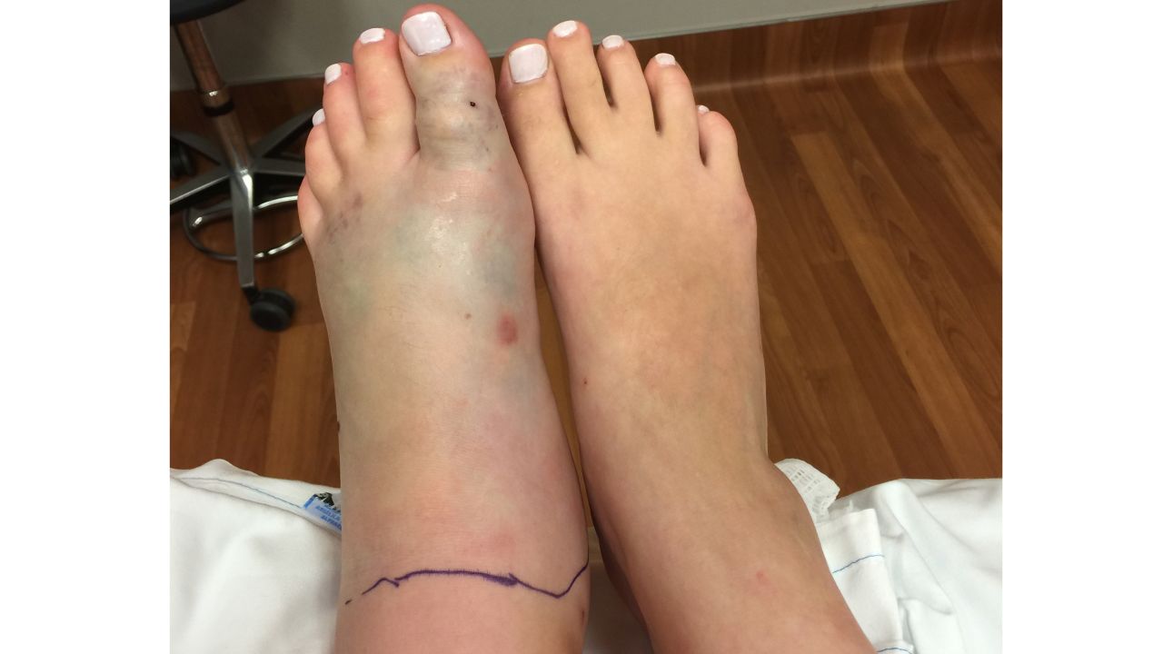 Meg Trammell's swollen snake-bitten foot as compared to her other foot