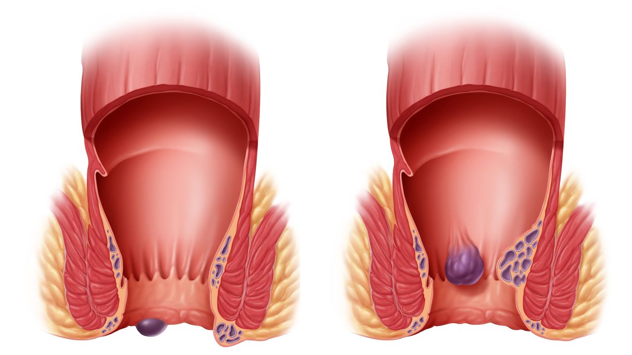 Hemorrhoids Dangers, treatments and prevention CNN