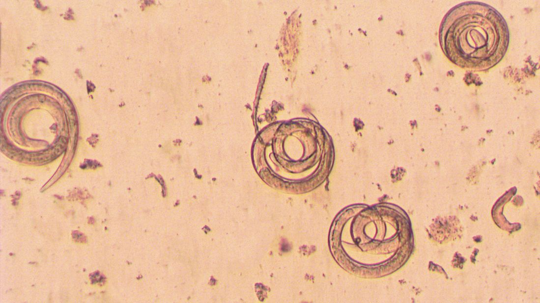 <strong>Trichinella spiralis:</strong> If a human or animal eats meat infected with Trichinella cysts, the Centers for Disease Control and Prevention says, their stomach acid dissolves the hard covering of the cysts. The worms pass into the small intestine, where they lay eggs that develop into immature worms, which travel through the arteries and into the muscles. There, they curl up and return to the original cyst formation, and the life cycle continues. Symptoms can include nausea, diarrhea, vomiting, headaches, fevers, chills, cough, facial swelling, aching joints and muscle pain. 