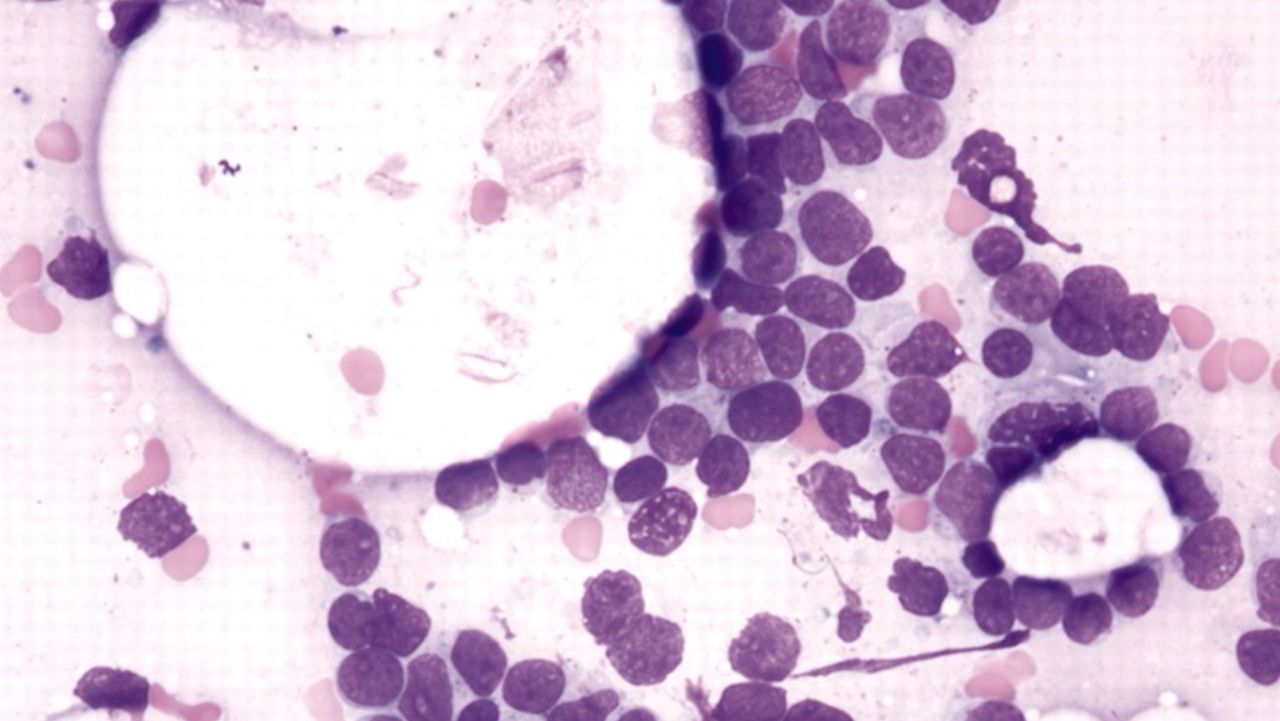 Leukemia T Cells